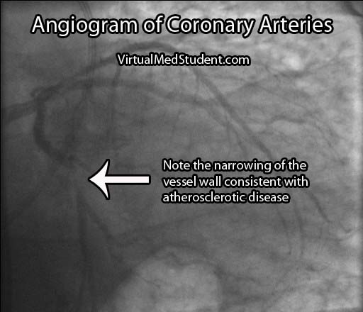 Angiogram Circumflex Atherosclerosis