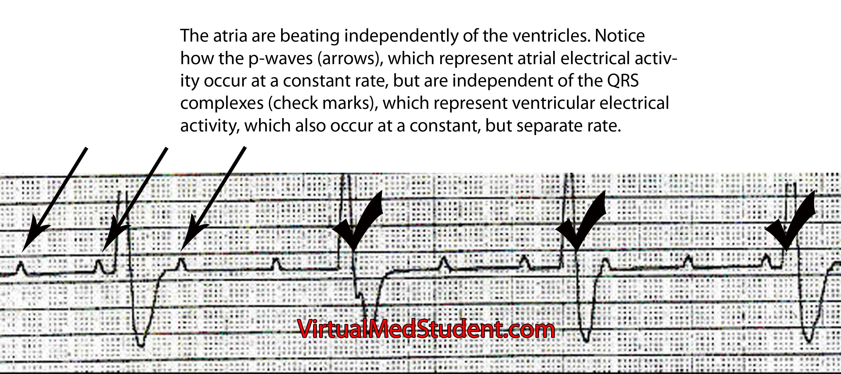 heart block type 3