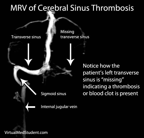MRV of Cerebral Sinus Thrombosis