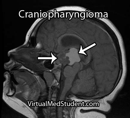 Craniopharyngioma MRI