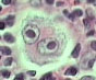 Reed-Sternberg Cell