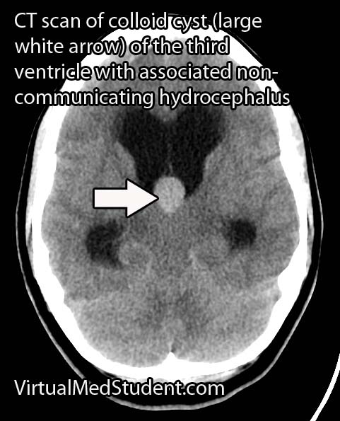 Non-communicating hydrocephalus