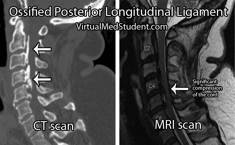 Ossified Posterior Longitudinal Ligament