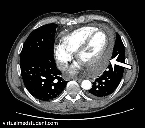 CT scan of pericardial effusion