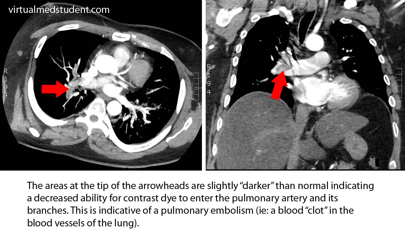 Pulmonary Embolus CT Scan