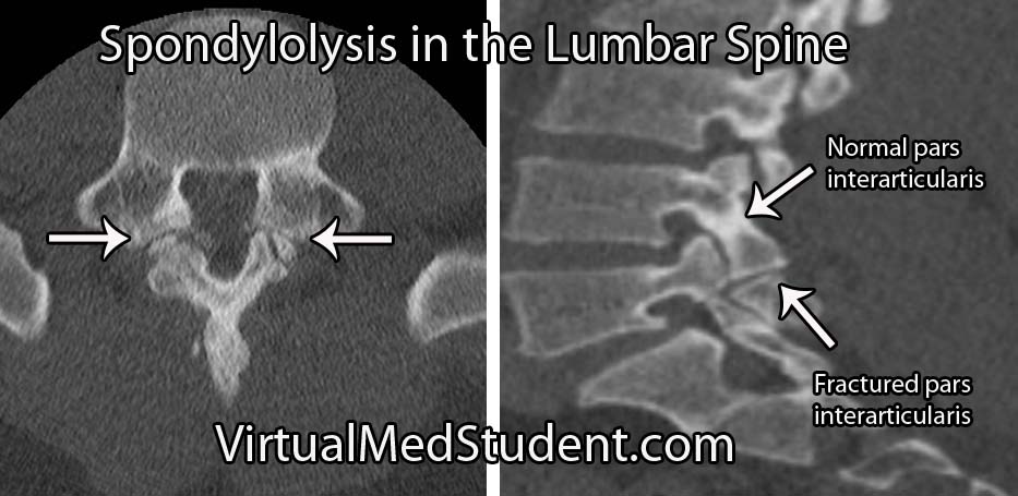 CT lumbar spondy