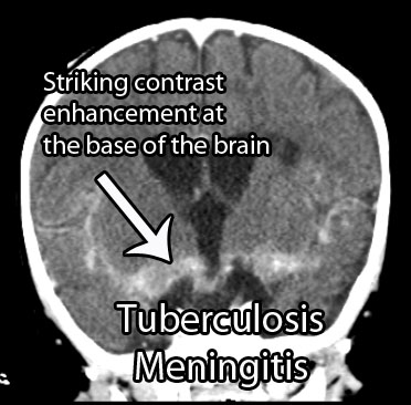 TB Meningitis CT