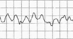 Ventricular fibrillation ECG