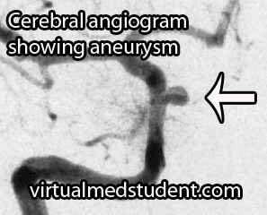 Cererbral Angiogram with Aneurysm