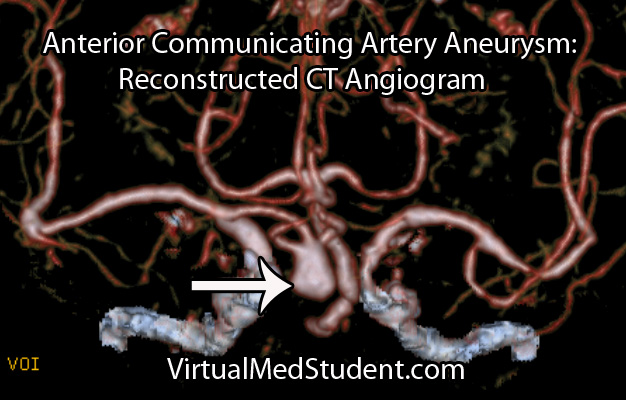 Anterior Communicating Artery Aneurysm CT Angiogram 