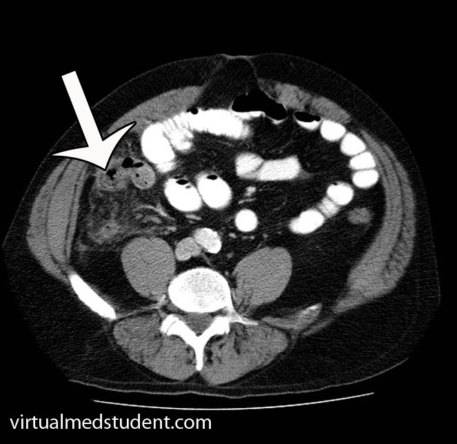 Appendicitis CT Scan