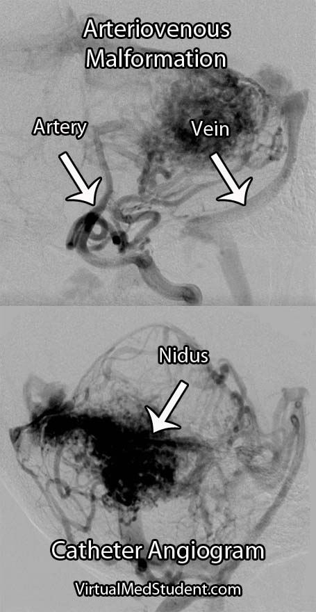 Cerebral Arteriovenous Malformation