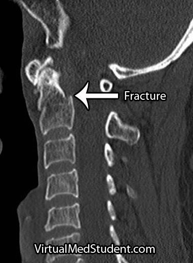 CT of odontoid fracture