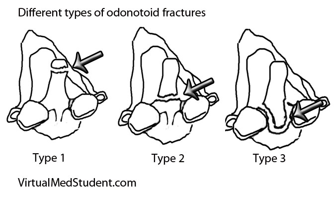 pt and ot after odontoid fracture