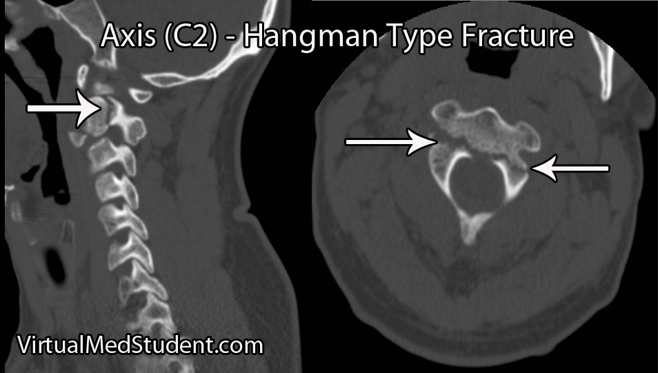 VirtualMedStudent.com || Hangman's Fracture