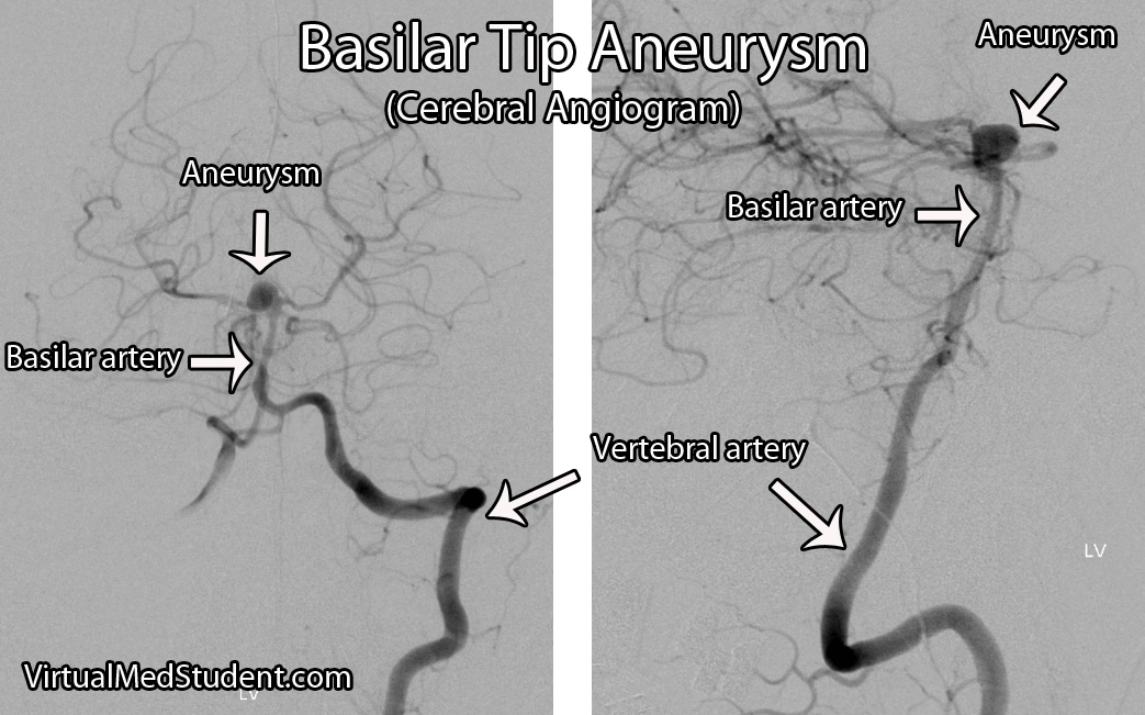 Angiogram of basilar tip aneurysm