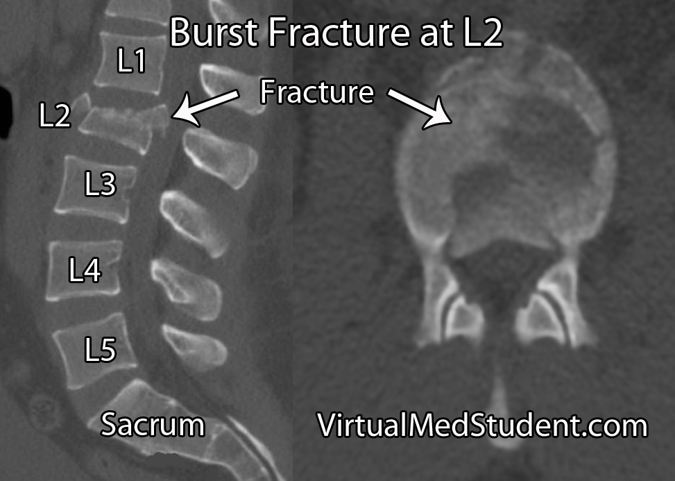 Burst Fracture Lumbar Spine