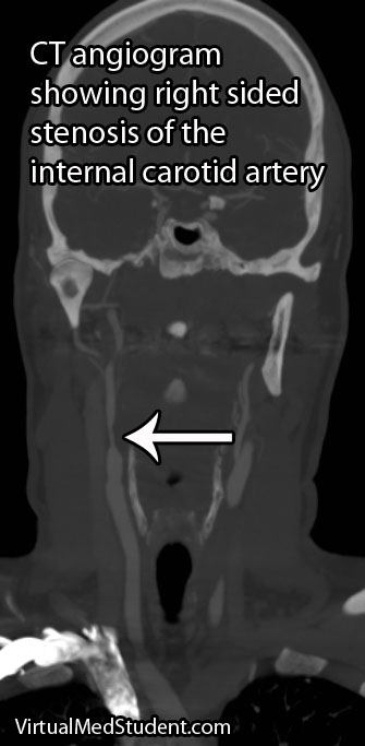 Carotid Stenosis