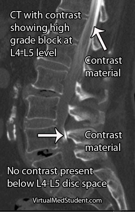 virtualmedstudent-cauda-equina-syndrome