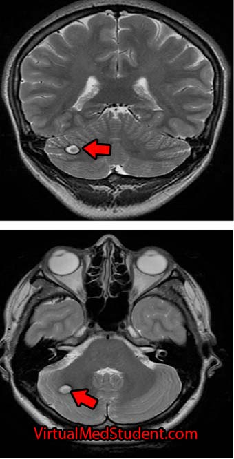 Cavernoma Marked