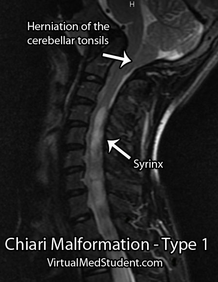 Type 1 Chiari Malformation