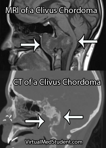 Clivus Chordoma