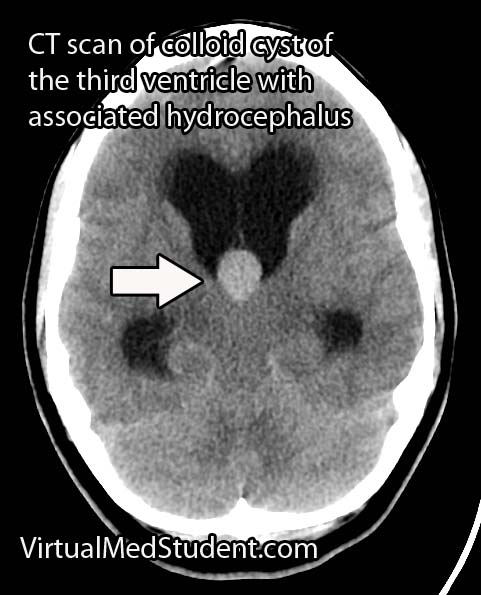 Colloid Cyst of the 3rd Ventricle CT