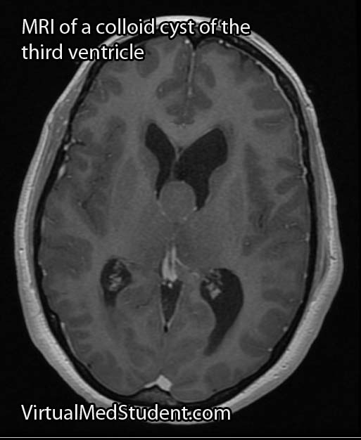 MRI of colloid cyst of the third ventricle