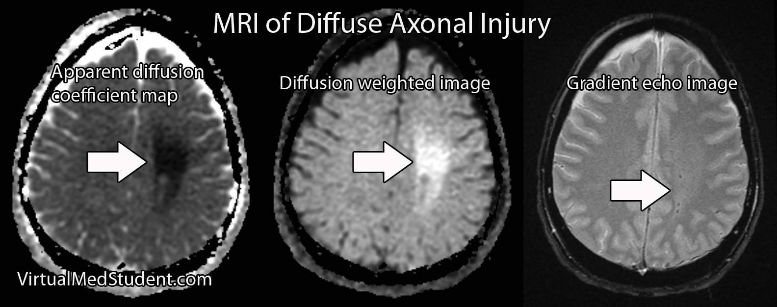 MRI of diffuse axonal injury