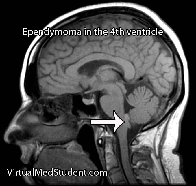 Ependymoma