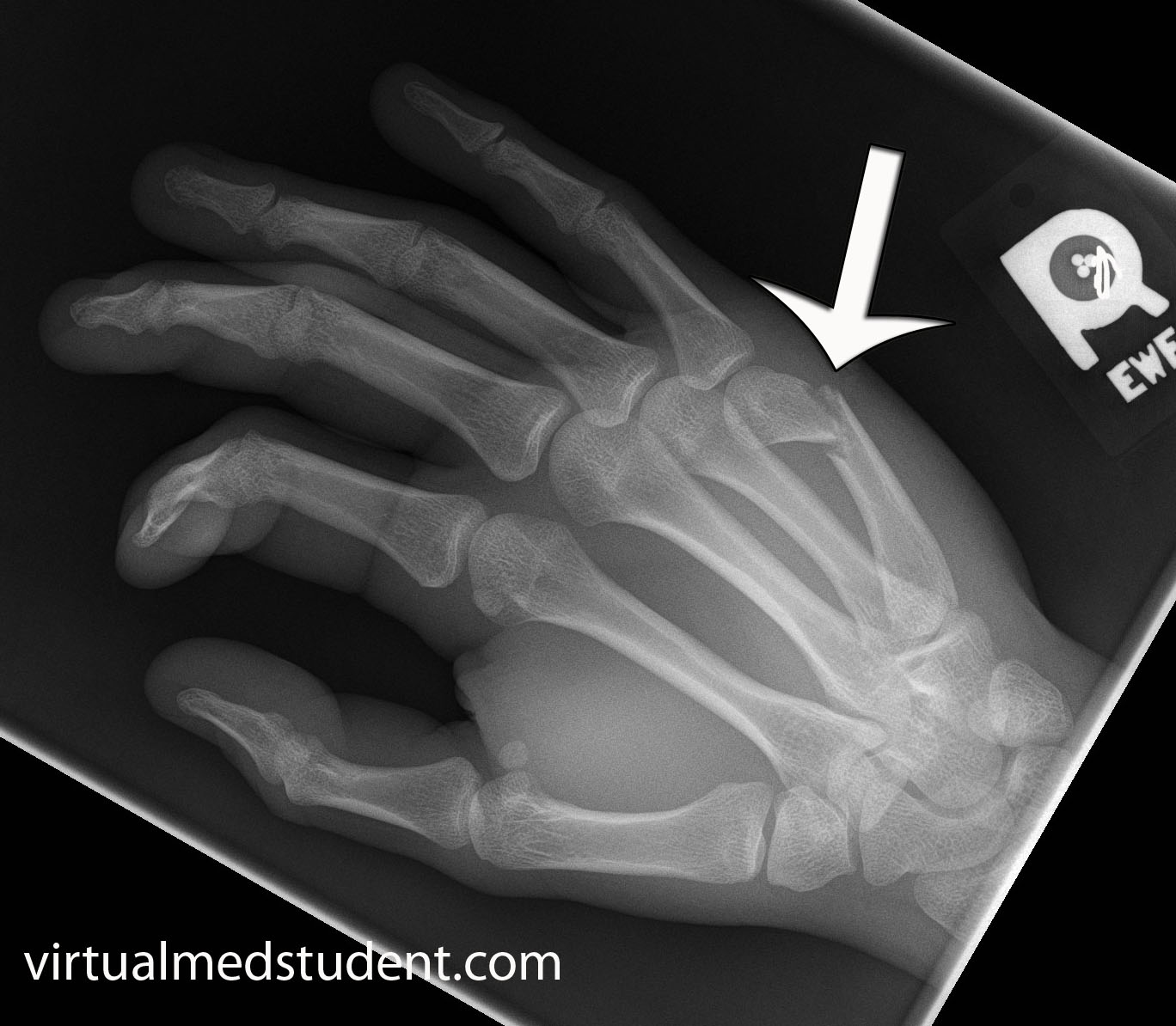 Signs And Symptoms Of A Boxer Fracture