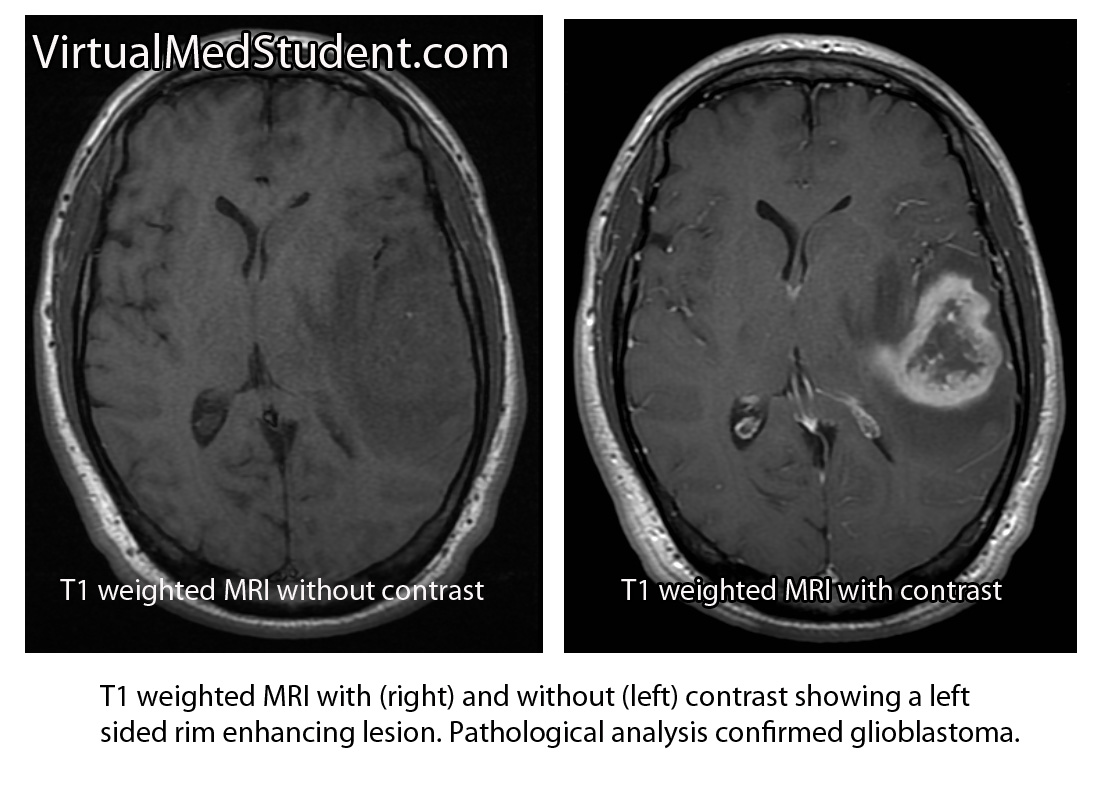 MRI of glioblastoma