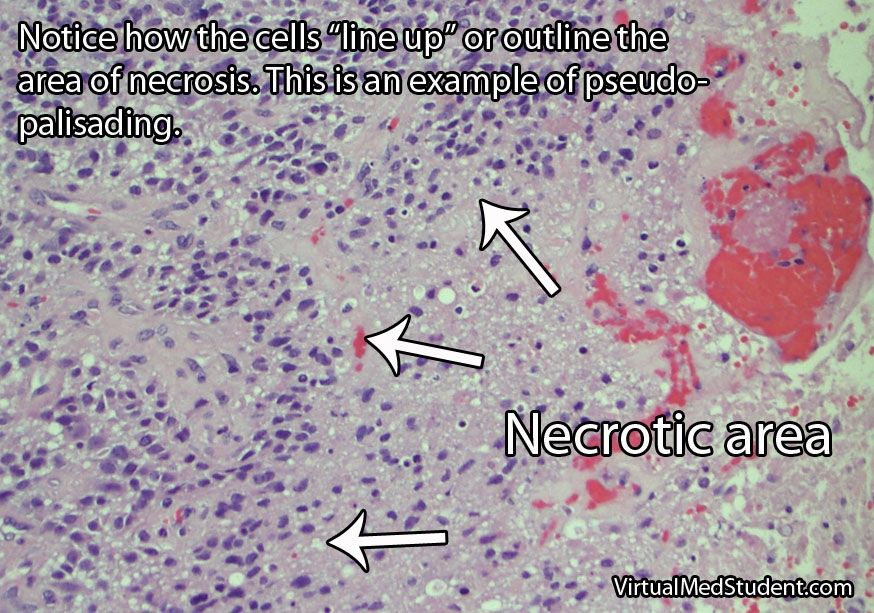 Glioblastoma Pathology - Pseudopalisading