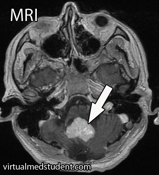Hemangioblastoma MRI