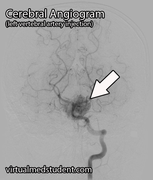 Hemangioblastoma Angiogram