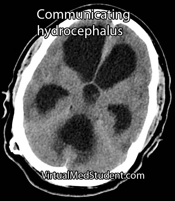 Communicating Hydrocephalus