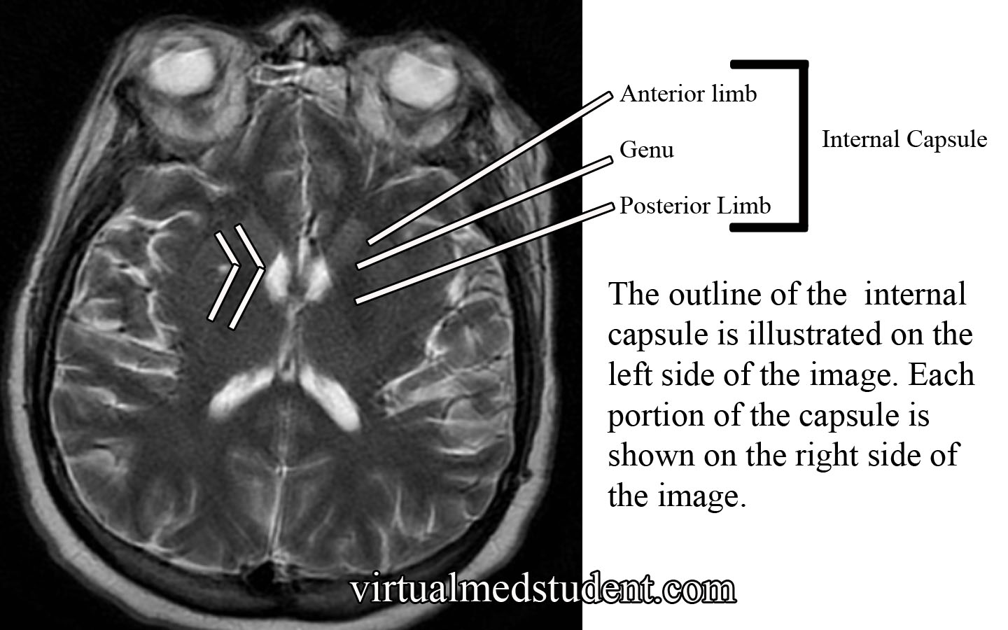 Internal Capsule MRI
