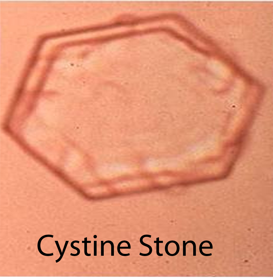 Cystine Stones