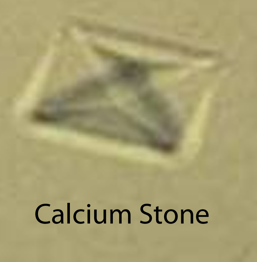 Calcium Kidney Stone