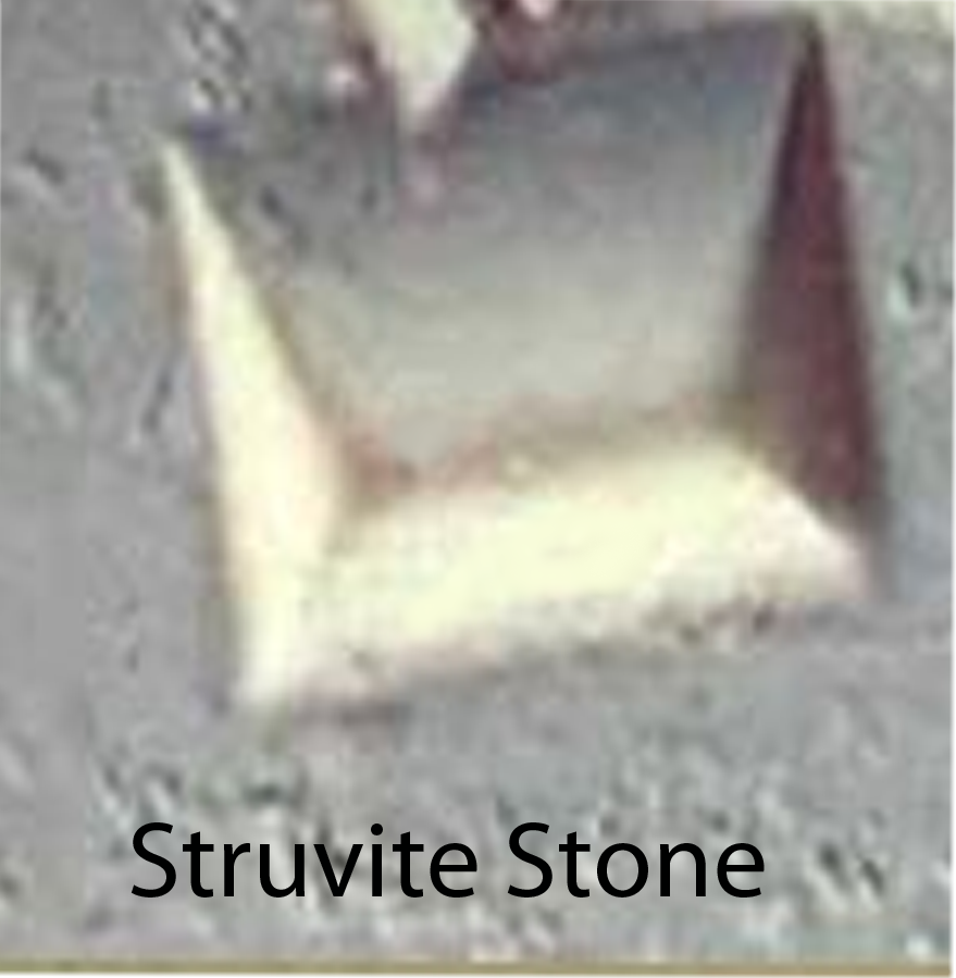 Struvite Stone