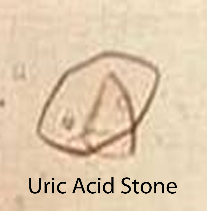 Uric Acid Stones