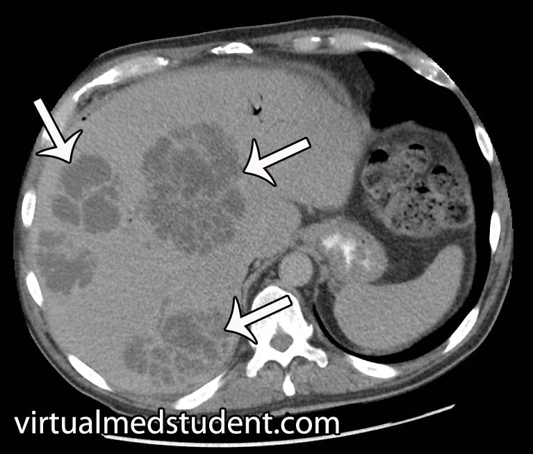 Pyogenic Liver Abscesses