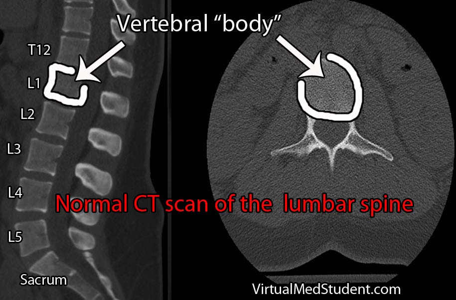 CT vertebral body