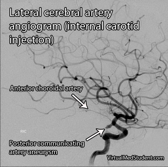 Cerebral angiogram showing anterior choroidal artery.