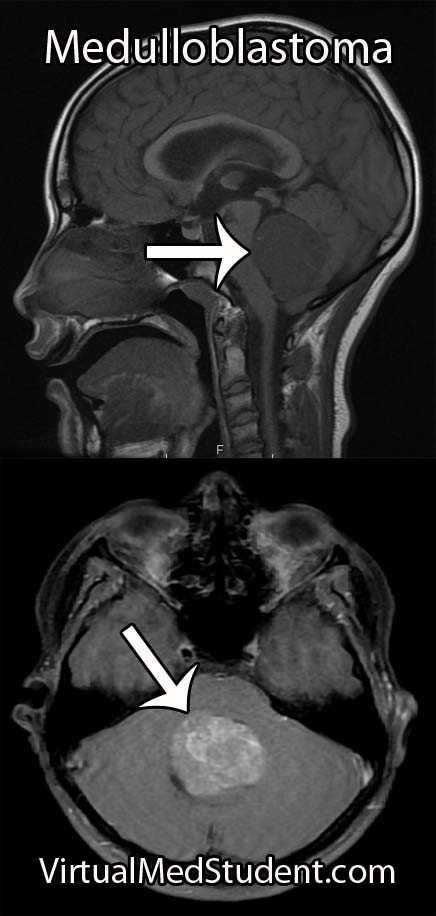 Medulloblastoma MRI