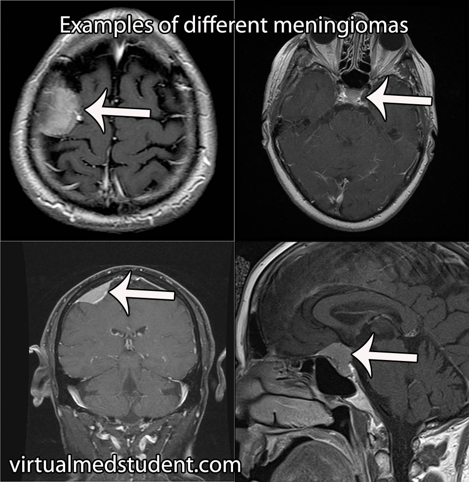 Meningioma MRIs