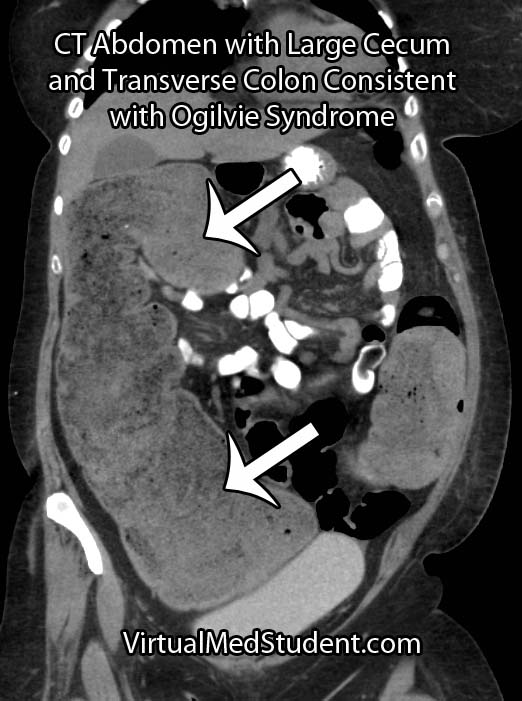 Ogilvie Syndrome CT Abdomen