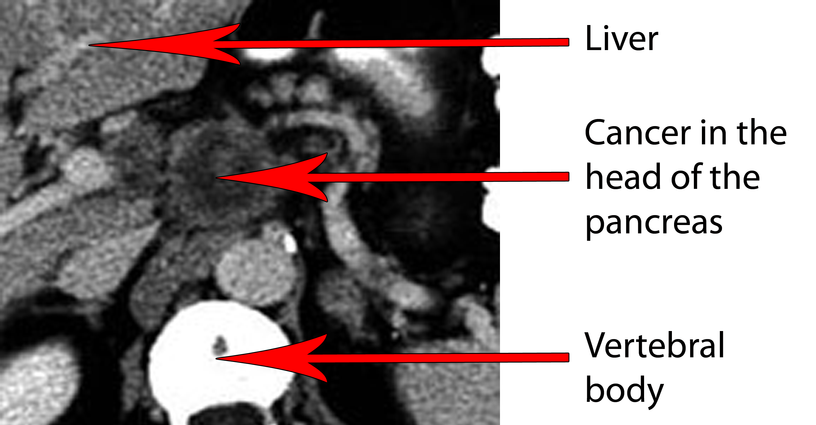 Pancreatic Adenocarcinoma CT