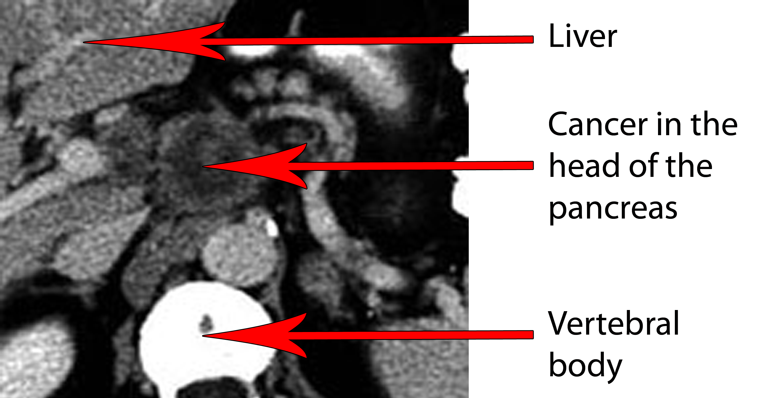 What Does Pancreatic Cancer Look Like On A Ct Scan Ct Scan Machine Images