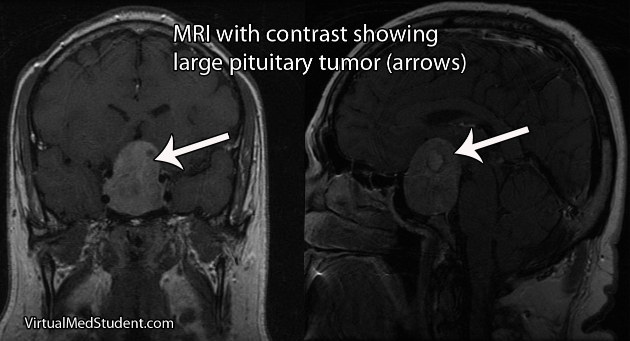 MRI of pituitary adenoma